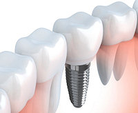 Dental Implants from Liberty Family Dentistry